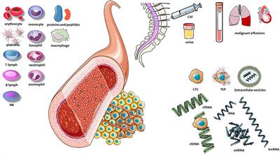 Preoperative Diagnosis and Molecular Characterization of Gliomas With Liquid Biopsy and Radiogenomics